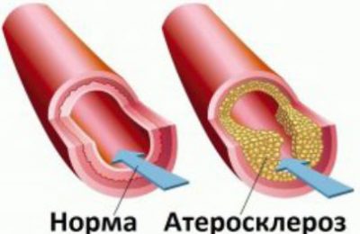 Берегите сосуды!